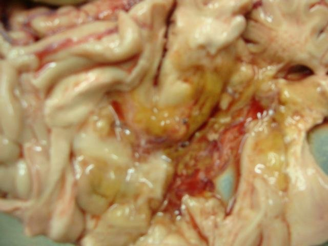 ischemic necrosis brain